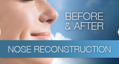 NoseReconstructionBA